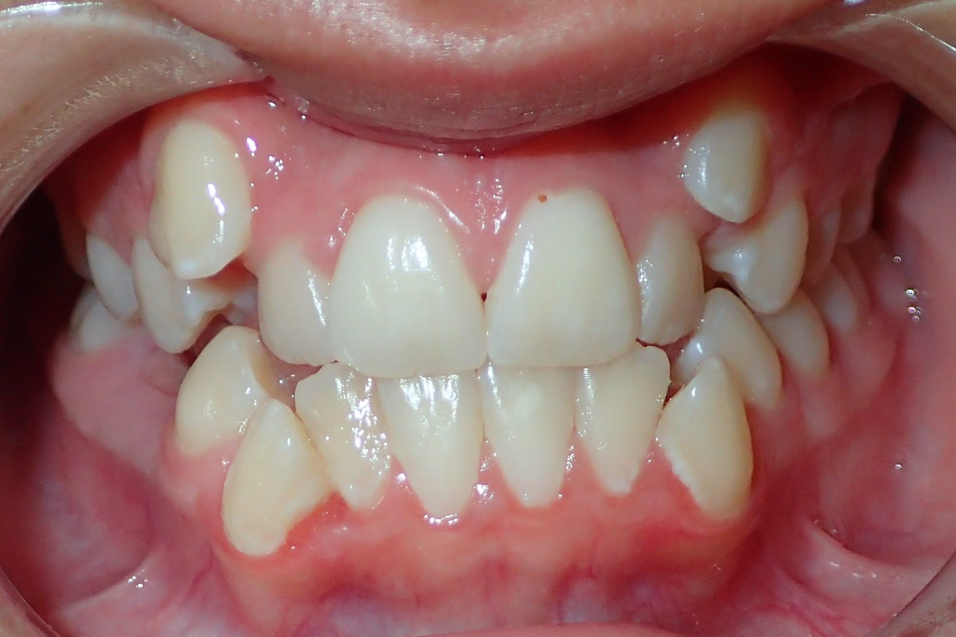 Before treatment: severe crowding, actual patient case at Bold Bite Orthodontics