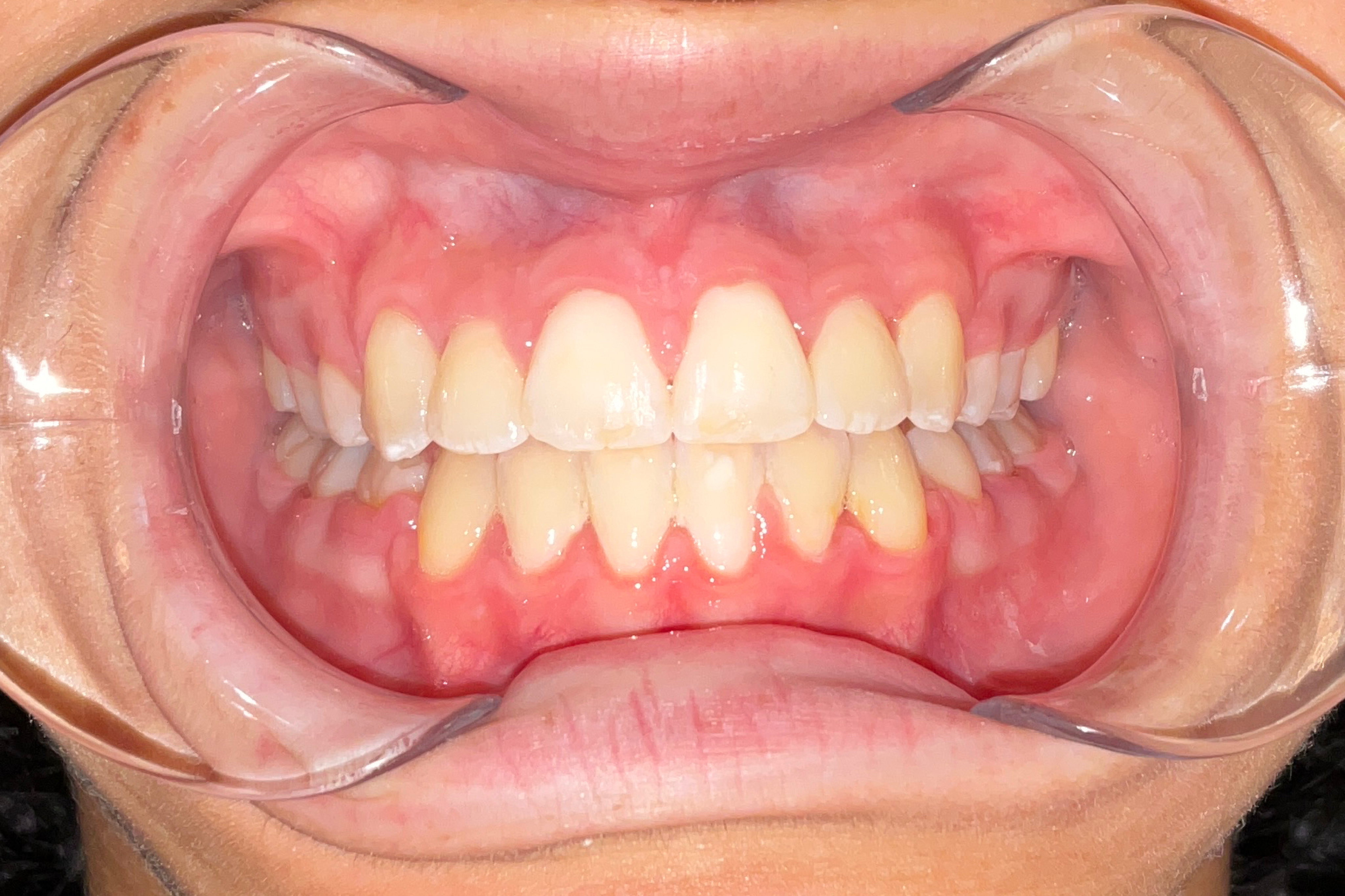 After treatment: aligned arch with crowding resolved at Bold Bite Orthodontics