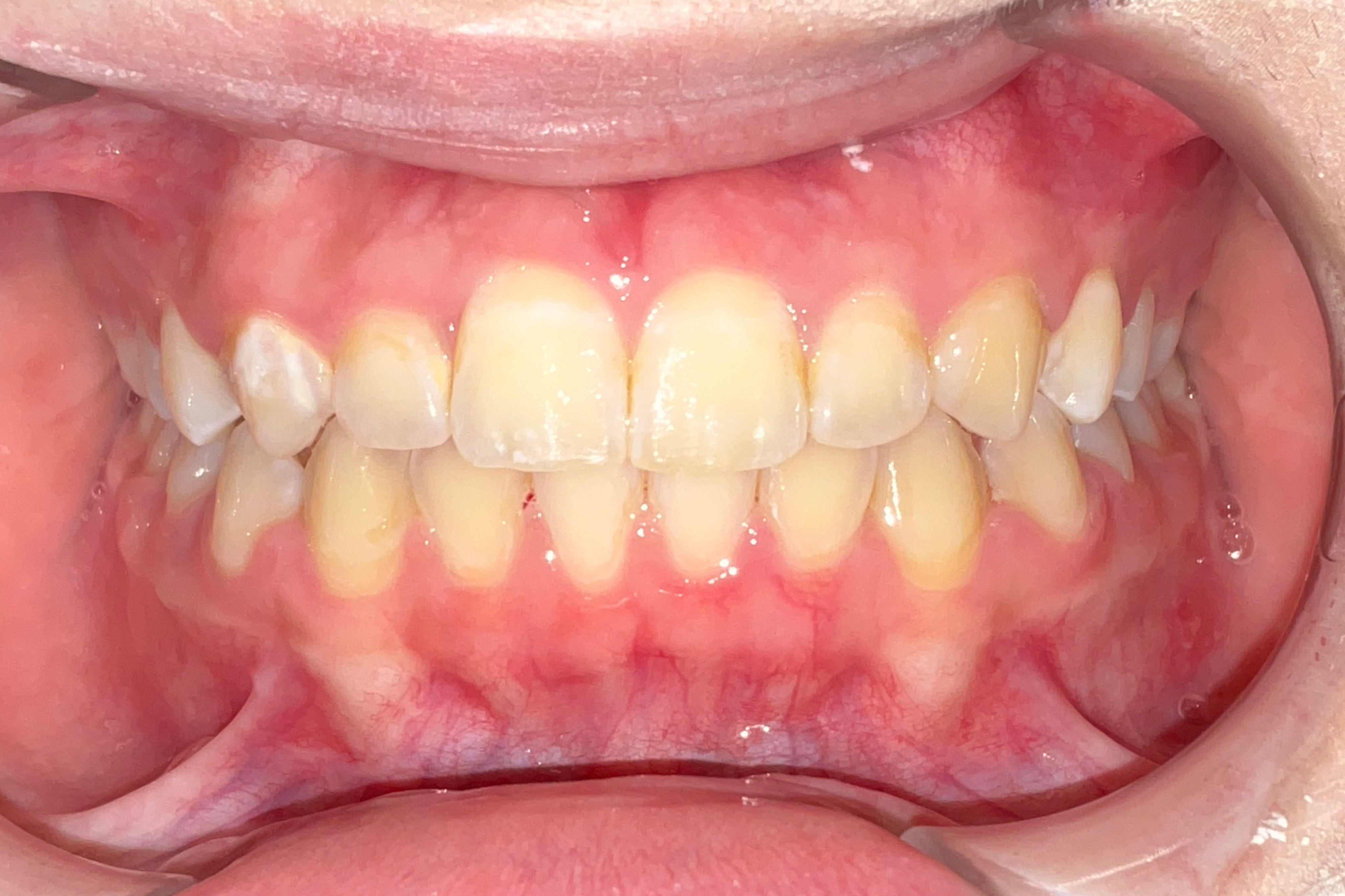 After treatment: corrected bite result, actual patient at Bold Bite Orthodontics