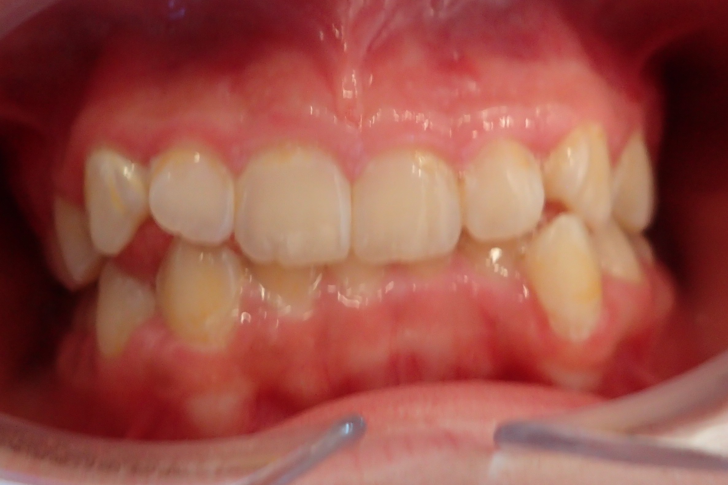 Before treatment: deep overbite case at Bold Bite Orthodontics in Jacksonville