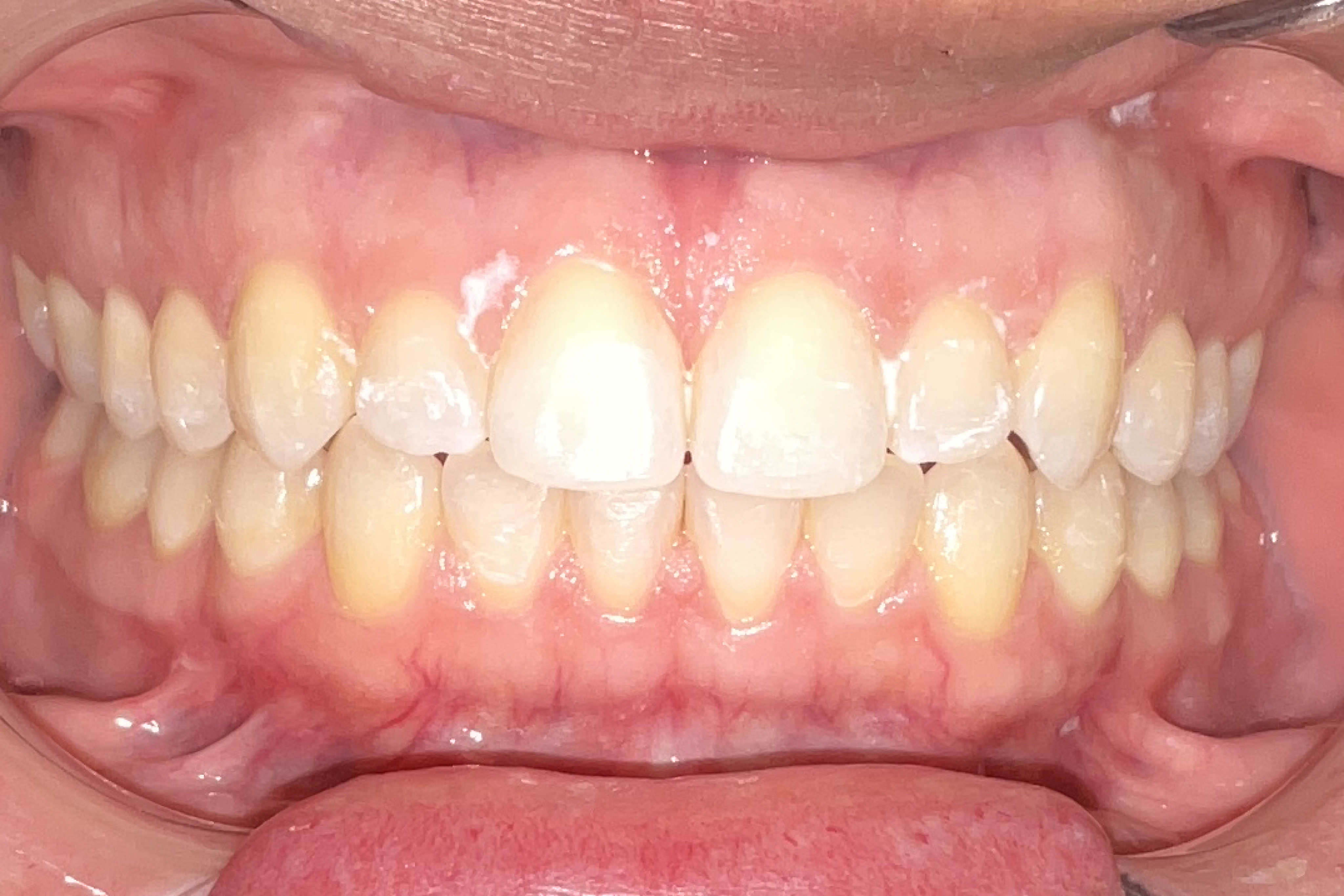 After treatment: adult Invisalign result at Bold Bite Orthodontics in Jacksonville