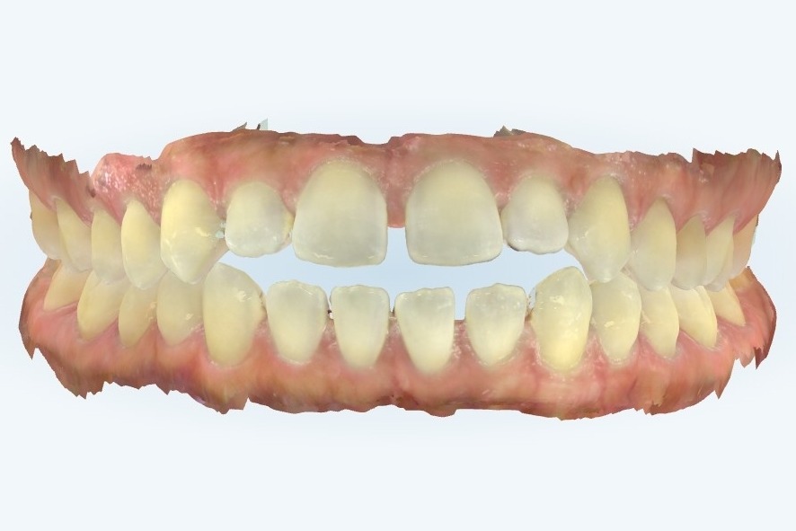 Before treatment: adult misalignment case at Bold Bite Orthodontics in Jacksonville