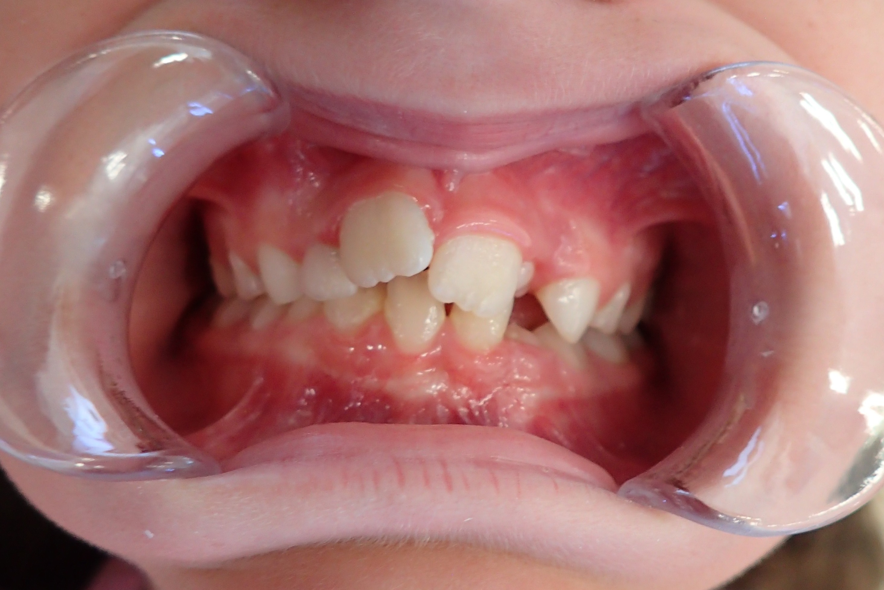 Crowded teeth treatment at Bold Bite Orthodontics