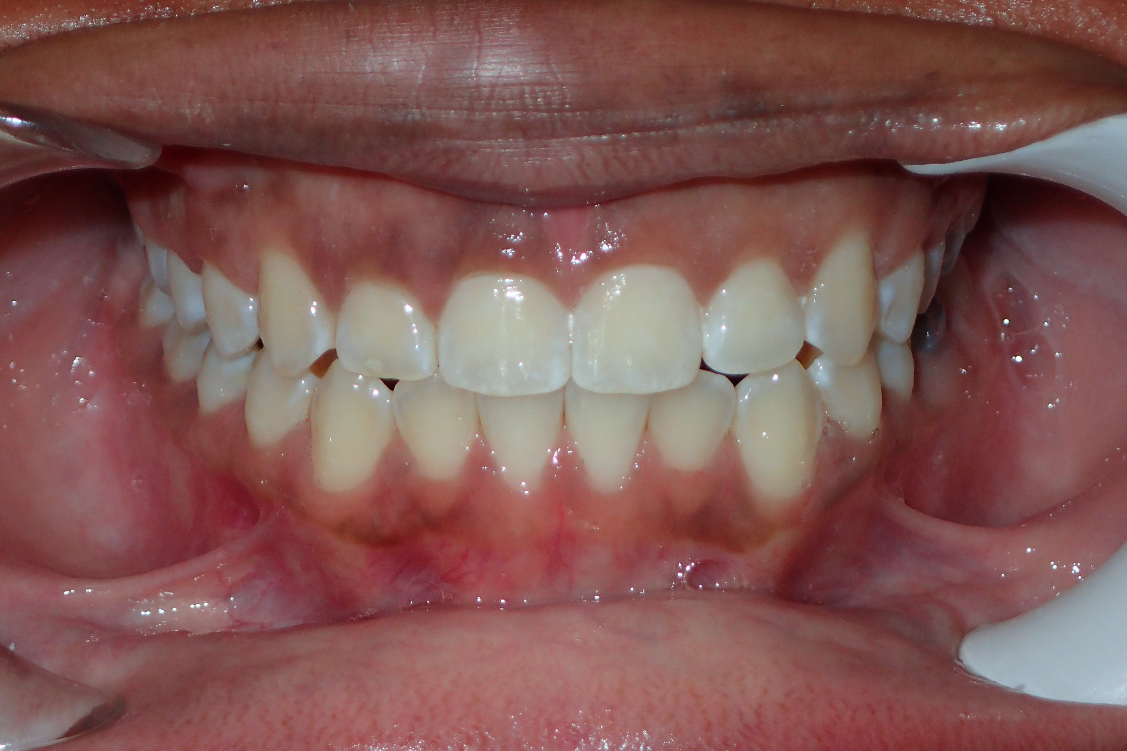 After treatment: Phase 1 expanded-arch result at Bold Bite Orthodontics in Jacksonville