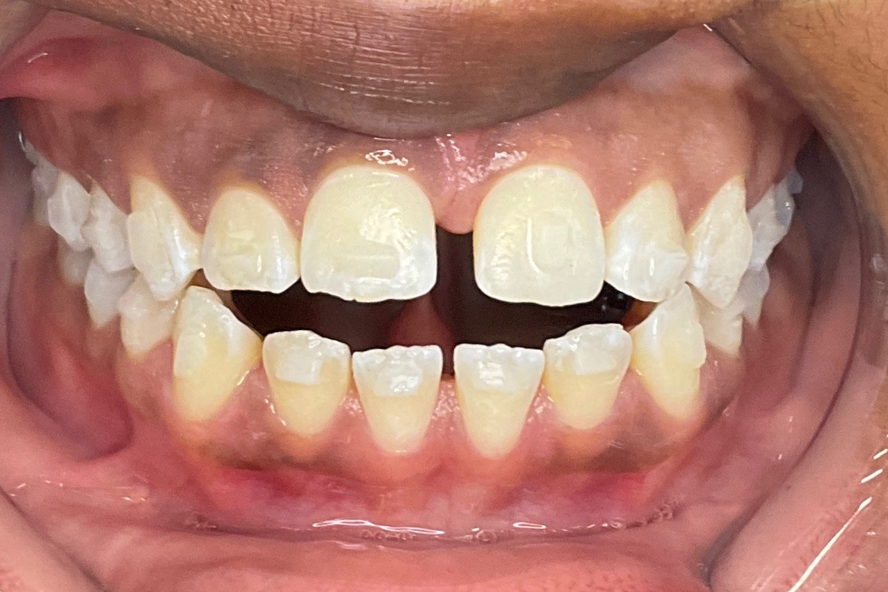 Before treatment: pediatric narrow arch, actual patient case at Bold Bite Orthodontics