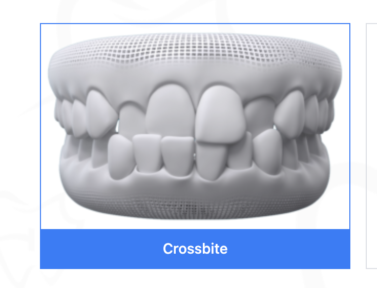 Crossbite correction at Bold Bite Orthodontics in Jacksonville