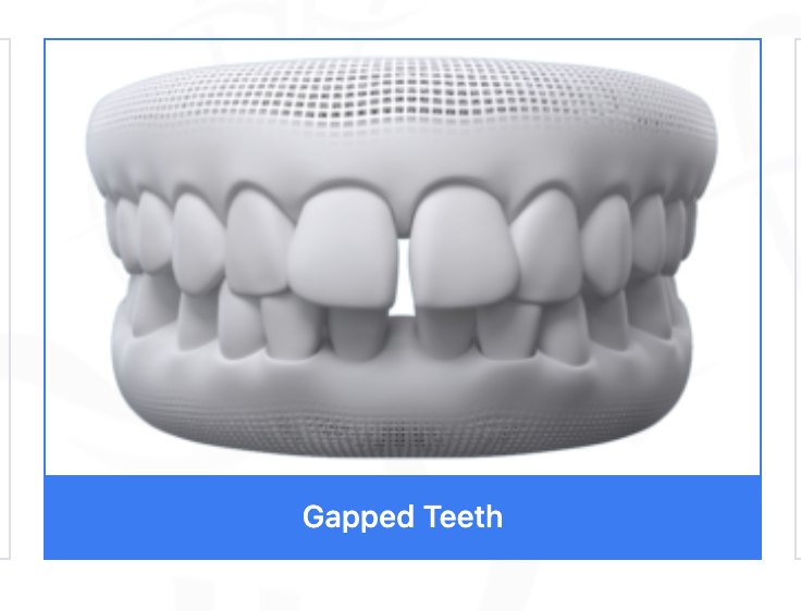 Teeth gaps and spacing evaluation and treatment at Bold Bite Orthodontics, Jacksonville
